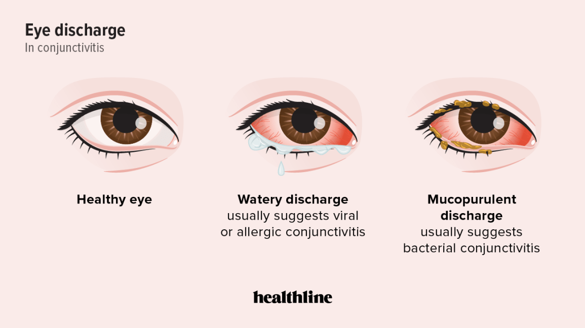 Mucopurulent Conjunctivitis Causes Symptoms And Treatment Austra Health 